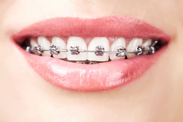 A close up of a woman's smile with metal braces.