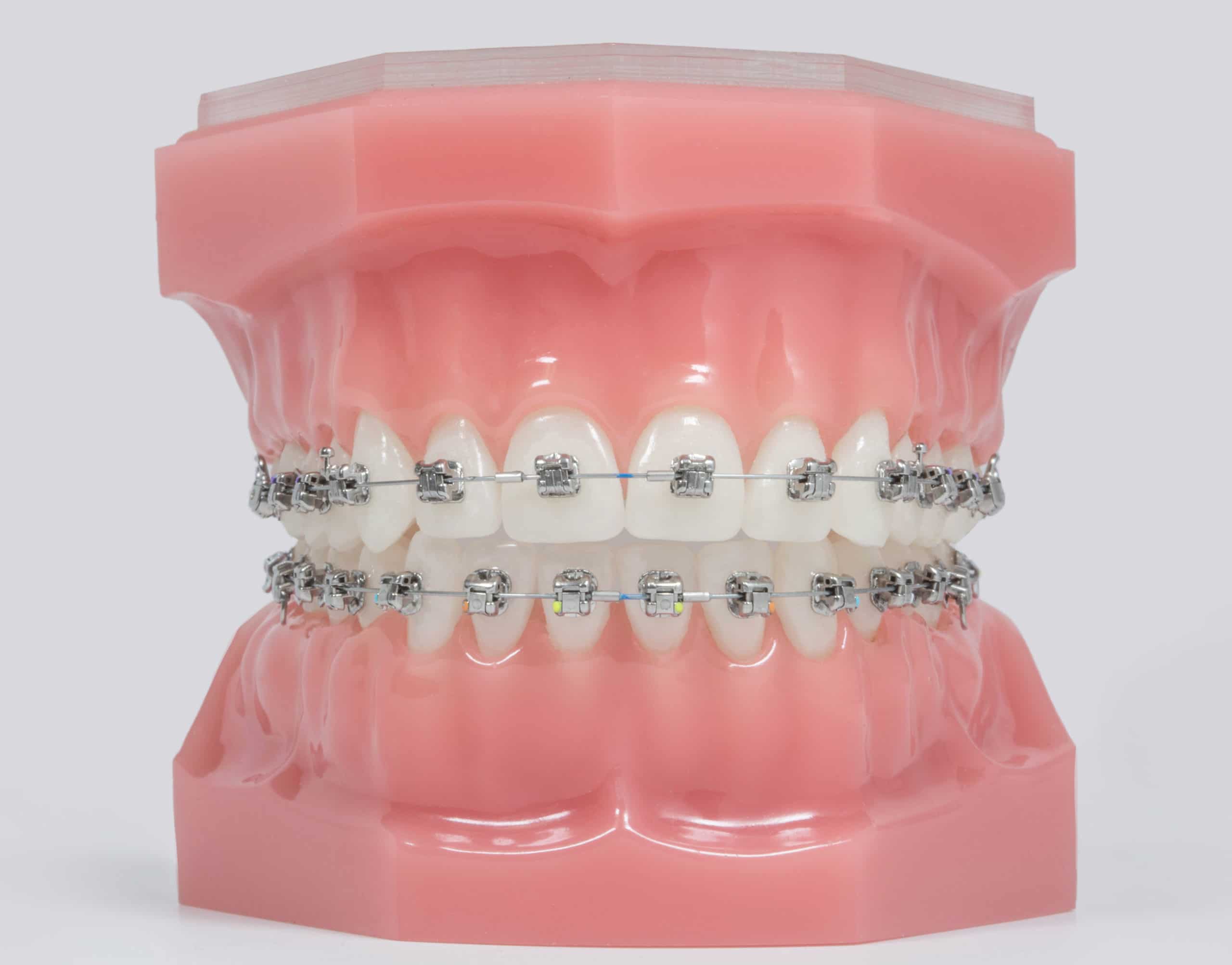 Model of teeth with Damon Metal Braces.