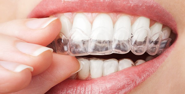 A close up of a woman's mouth while she is apply a clear aligner tray.