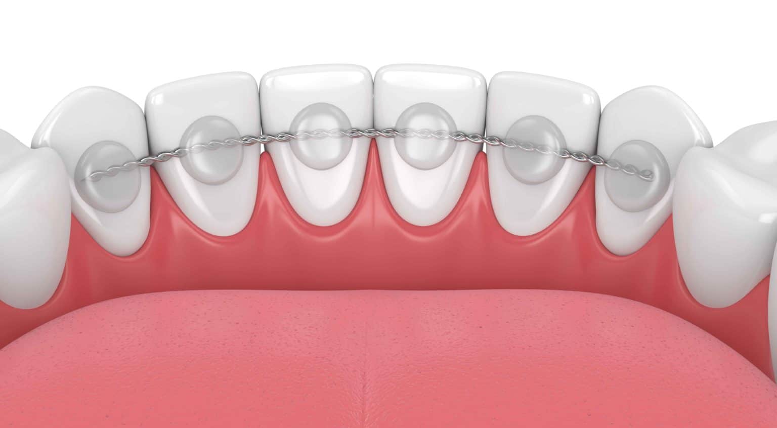 Retaining Your New Smile Bovenizer & Baker Orthodontics