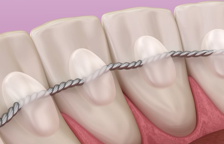 Retainers dental installed after braces treatment, Medically accurate dental 3D illustration