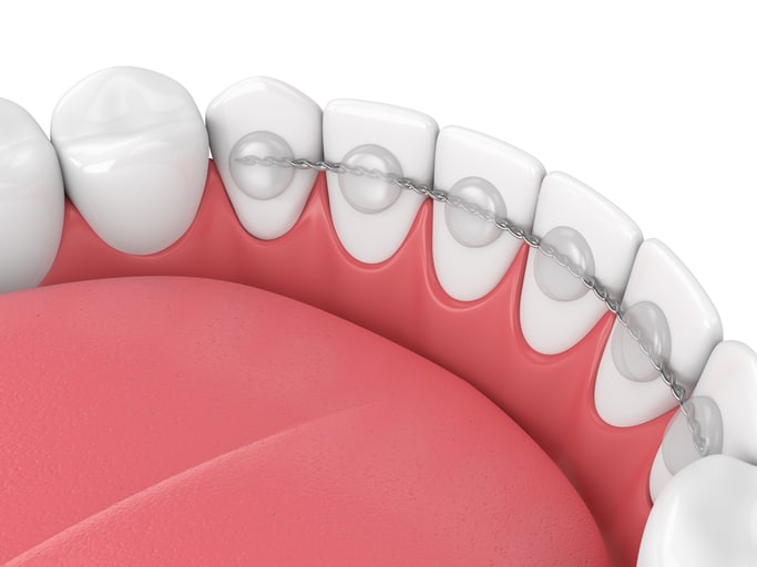 permanent retainer on back of teeth