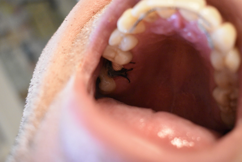 Close up of a mouth with stitches after a molar extraction.