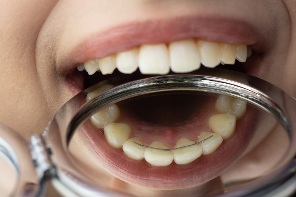 Close up of a mouth with a mirror being held under the top teeth.
