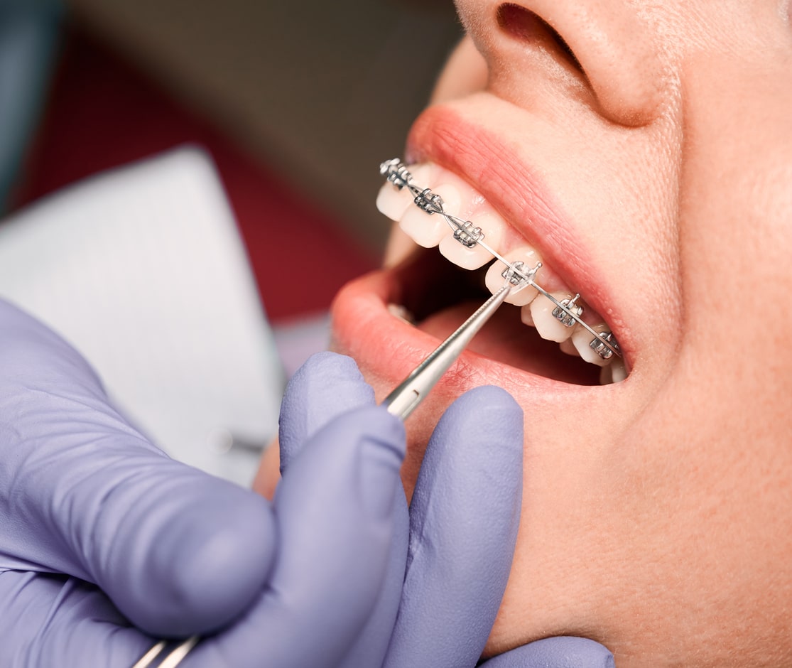Orthodontist placing rubber bands on female patient braces.